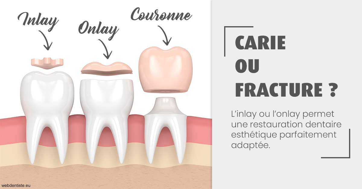 https://dr-olivier-lemaire.chirurgiens-dentistes.fr/T2 2023 - Carie ou fracture 1