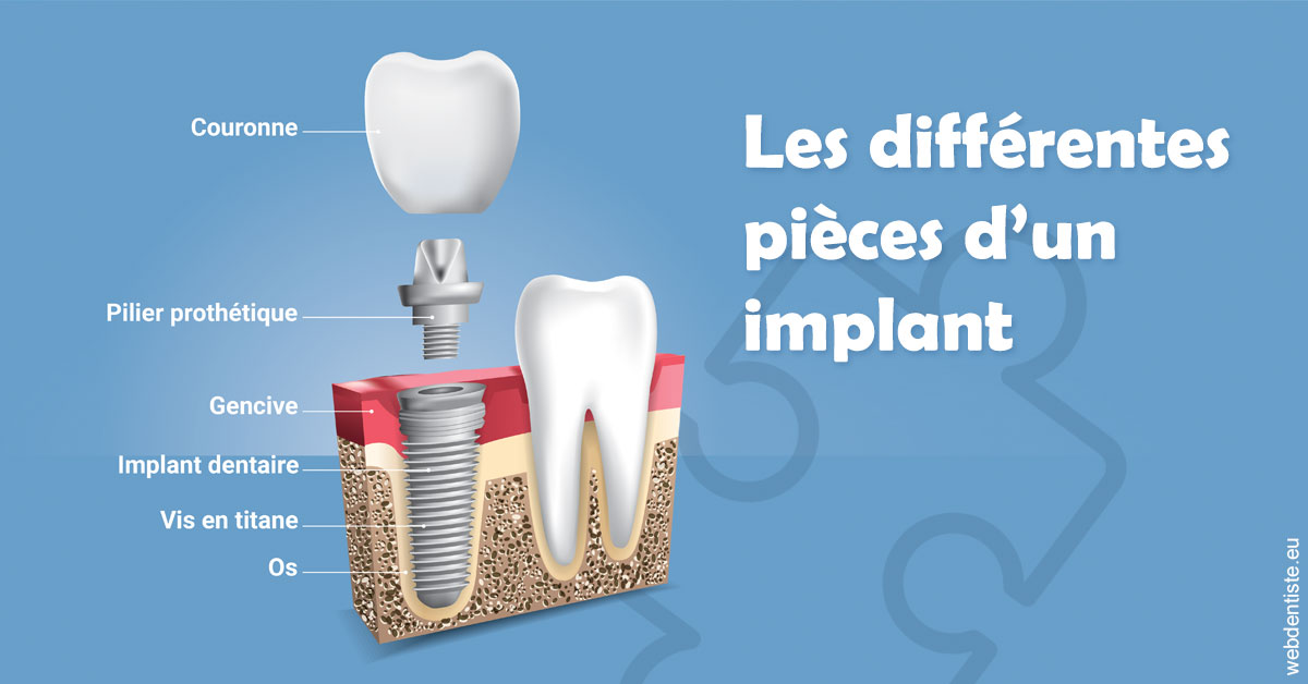 https://dr-olivier-lemaire.chirurgiens-dentistes.fr/Les différentes pièces d’un implant 1
